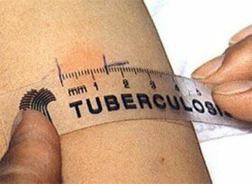 Проблема туберкулеза у детей